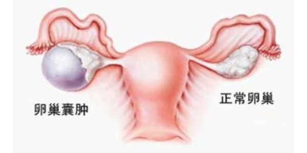 事实证明，多囊卵巢综合症的危害很大，太可怕了!