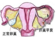 什么是女性卵巢早衰？原因何在？