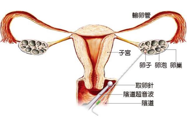 宁波供卵中介qq群：我如何为我的美国试管婴儿选择正确的排卵方案？