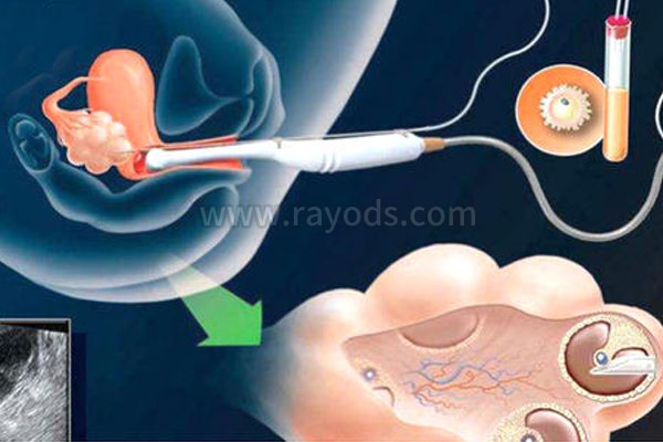 广州试管婴儿借腹生子-广州试管婴儿手术疼吗？